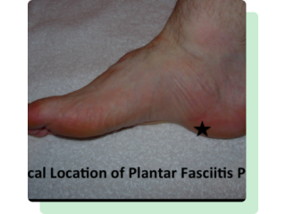 Surgery To Fix Flat Feet